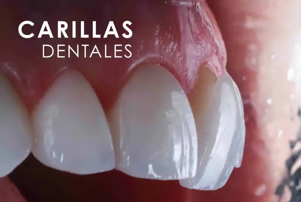 CARILLAS-DENTALES-scaled-1-1024x687