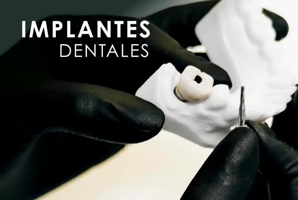 IMPLANTES-DENTALES-scaled-1-1024x687