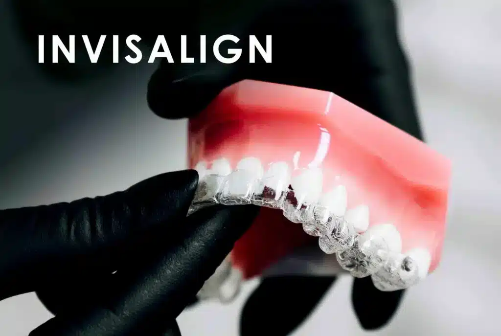 INVISALIGN-scaled-1-1024x687