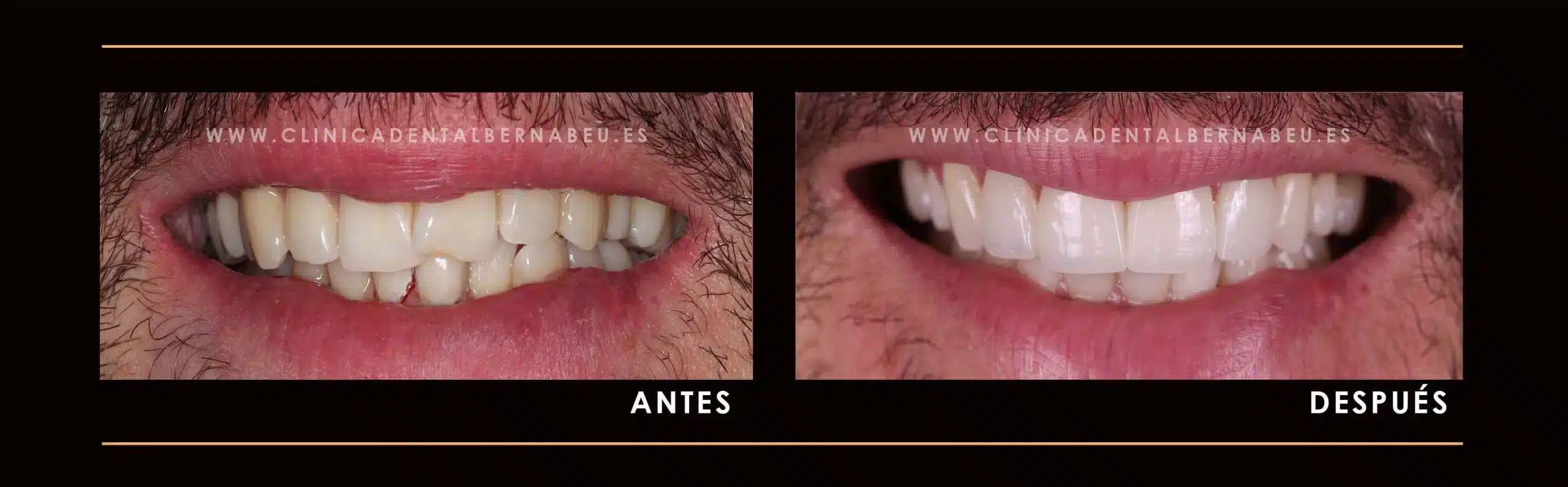 CARILLAS-DENTALES2-scaled (1)