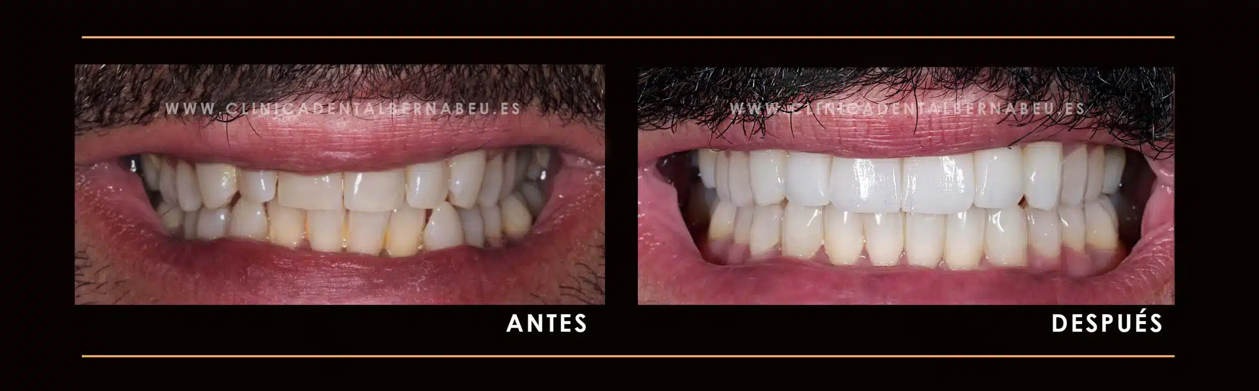 CARILLAS-DENTALES3-scaled (1)