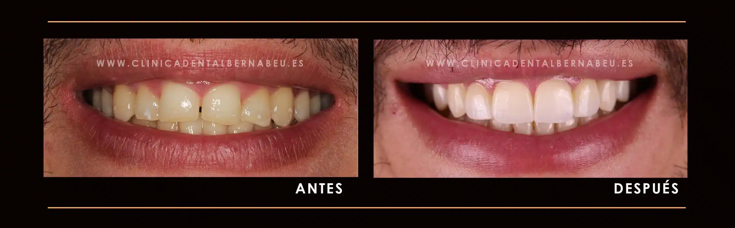 CARILLAS-DENTALES8-scaled (1)