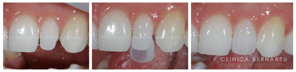 carilla-estetica-feldespatica-1024x252