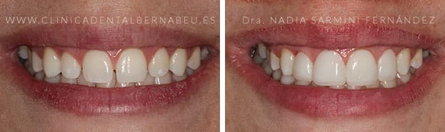 carillas-dentales-composite