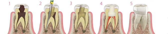 endodoncia2