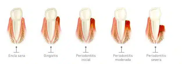 periodoncia2