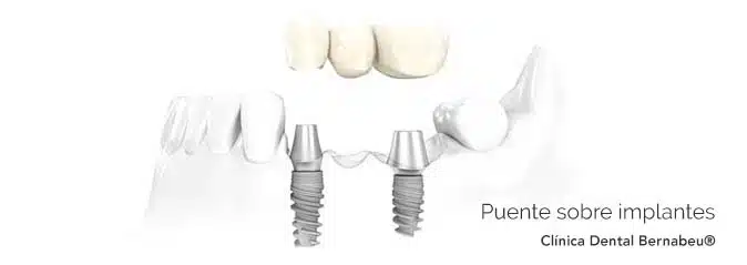 protesis-dental-implantes