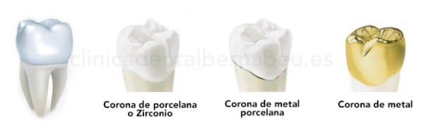 corona-zirconio-600x188