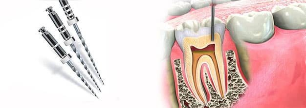 endodoncia-multirradicular-que-es