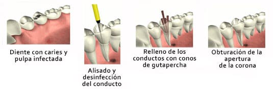 endodoncia-uniradicular-tratamiento