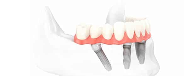 implantes-carga-inmediata