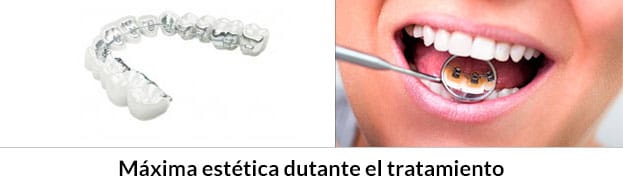 Los brackets autoligables Damon