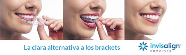 Brackets Invisalign Madrid