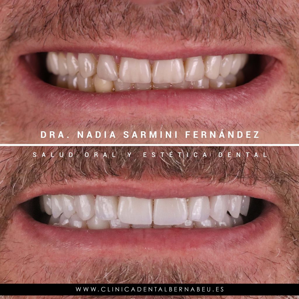 ANTES Y DESPUÉS