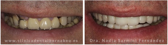 Diferentes tipos de coronas