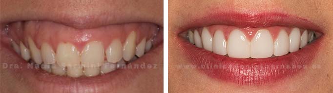 Gingivectomia | Antes y después | Carillas daVinci