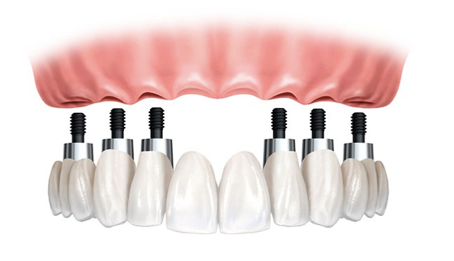 Pieza de tratamiento de dentadura fija en Madrid