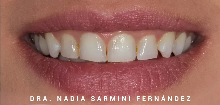 ceramica emax antes