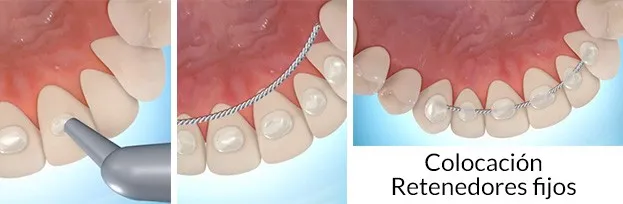 Retenedor de ortodoncia fijo