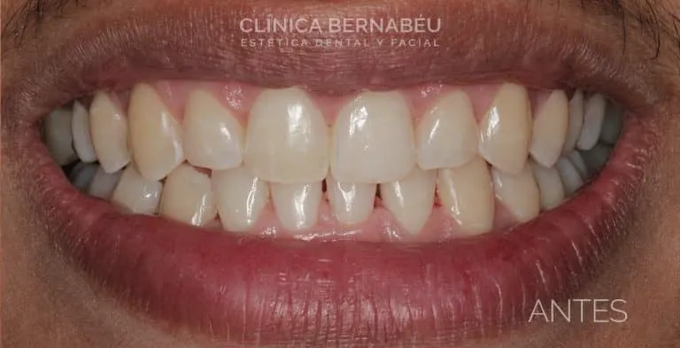 Resultado de blanqueamiento dental LED en Madrid