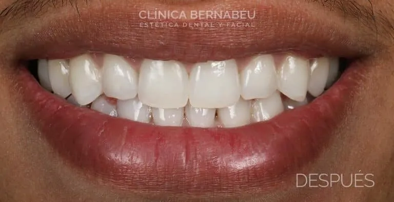 Resultado de blanqueamiento dental LED en Madrid
