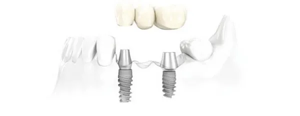 precio de implantes