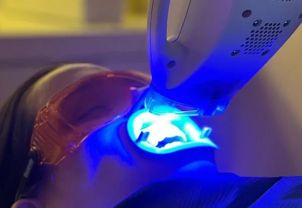 Blanqueamiento dental LED en paciente en Madrid