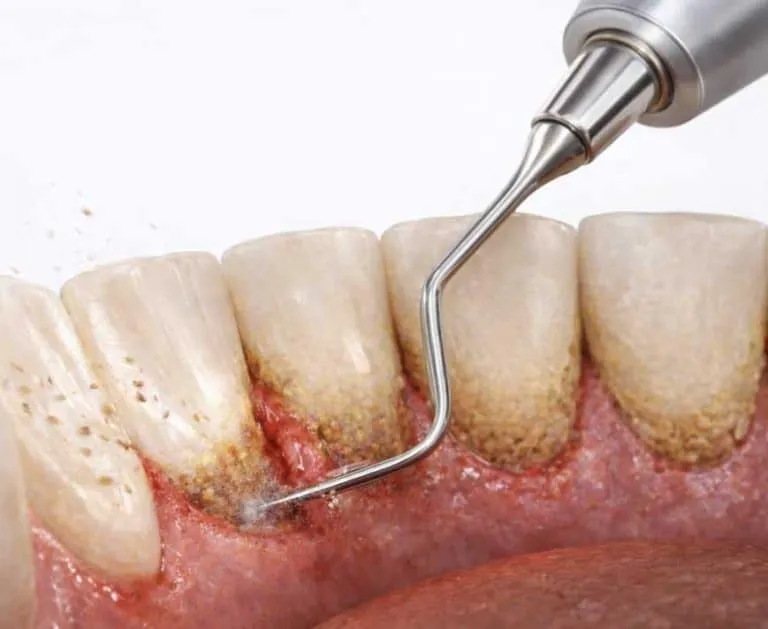 Instrumental Curetaje dental