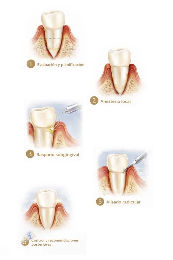 Procedimiento del curetaje dental