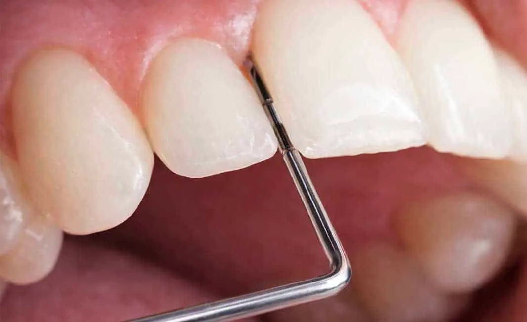 Exploración periodontal
