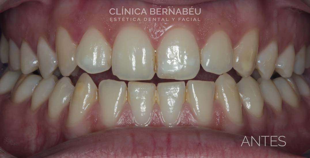 Caso real estética dental Antes