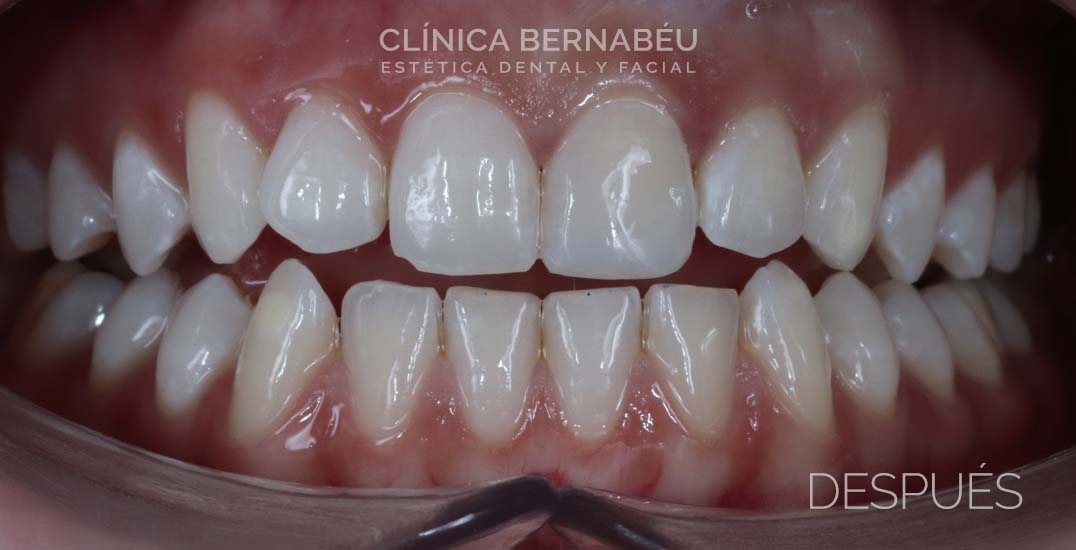 Caso real después de estética dental