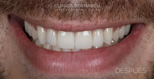 Resultado después del tratamiento de estética dental en Clínica Dental Bernabéu Madrid