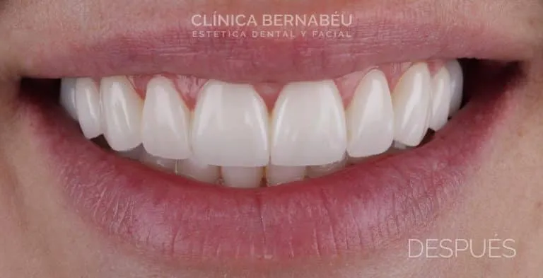 Resultado de carillas LightVeneers sin tallado — primer plano — Clínica Dental Bernabéu Madrid